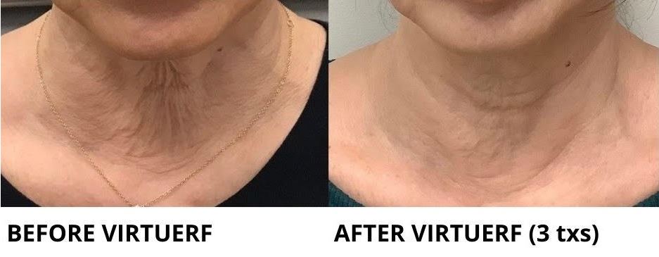 VirtueRF Microneedling