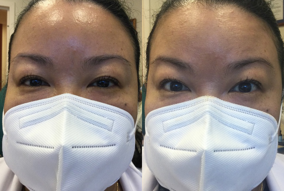 UPNEEQ® (30 single-use containers)