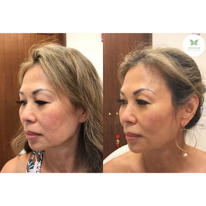 Sculptra®