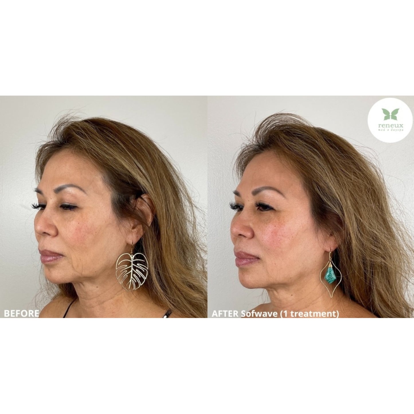 Sofwave (Ultrasound-based Skin Tightening)