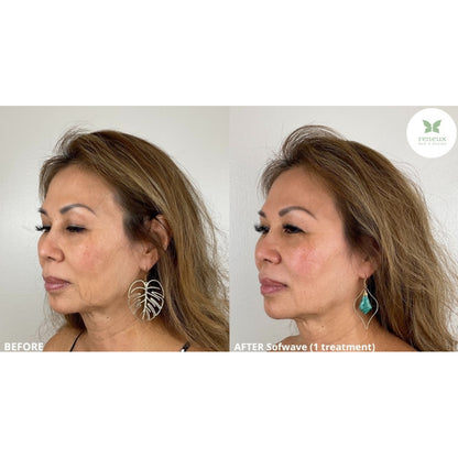 Sofwave (Ultrasound-based Skin Tightening)