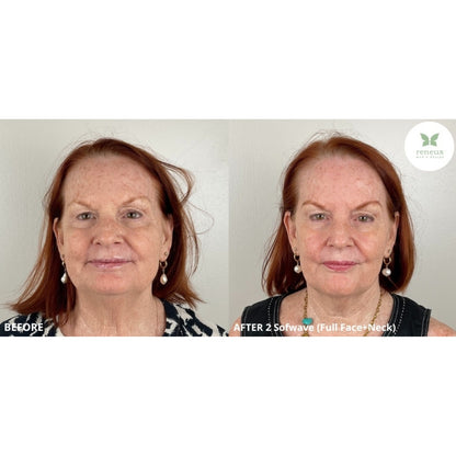 Sofwave (Ultrasound-based Skin Tightening)