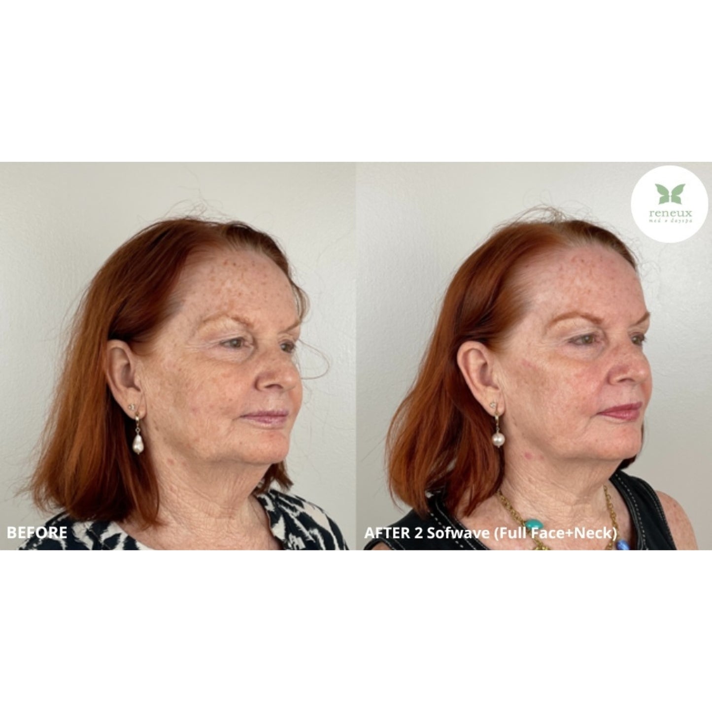 Sofwave (Ultrasound-based Skin Tightening)