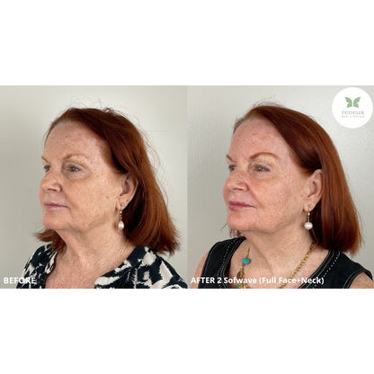 Sofwave (Ultrasound-based Skin Tightening)