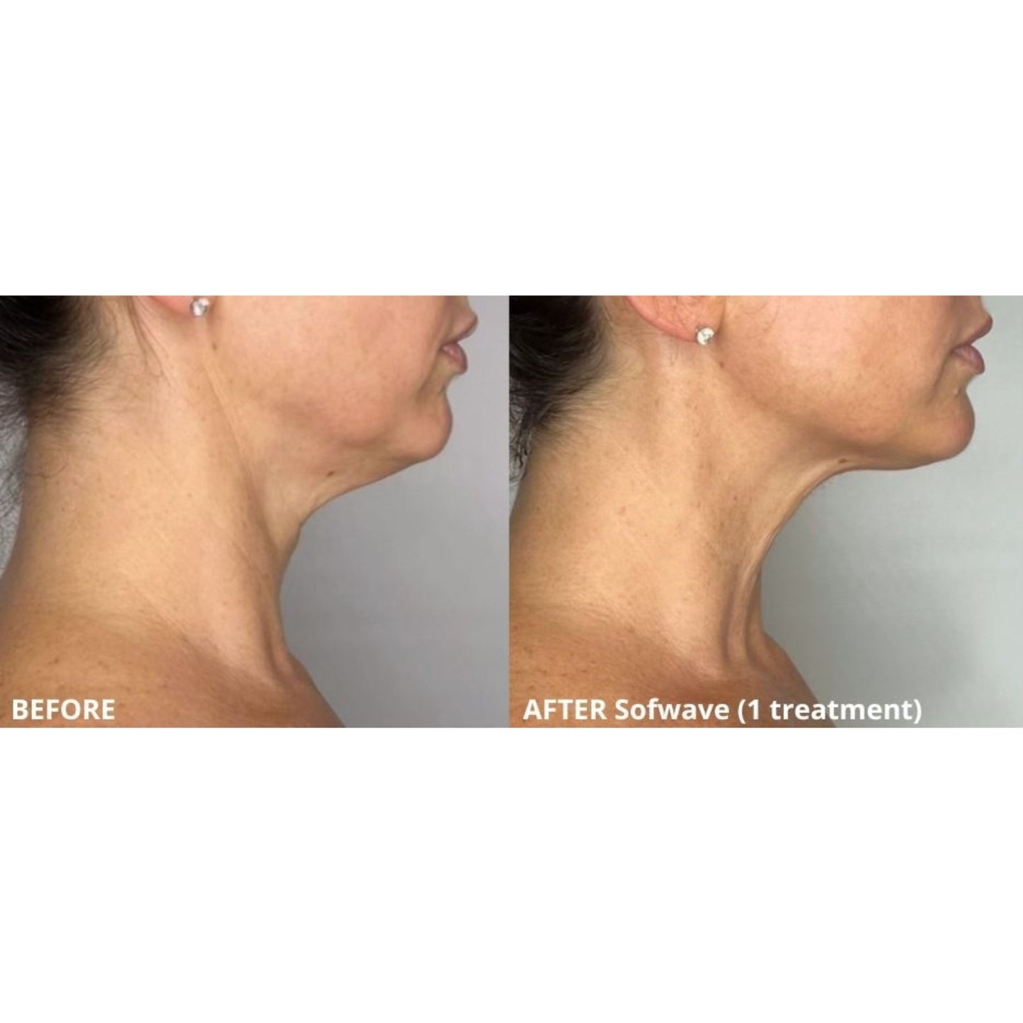 Sofwave (Ultrasound-based Skin Tightening)