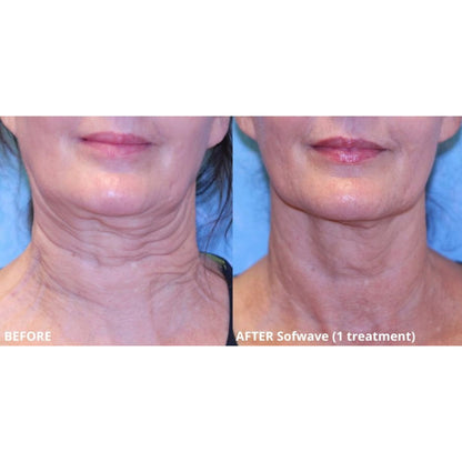 Sofwave (Ultrasound-based Skin Tightening)