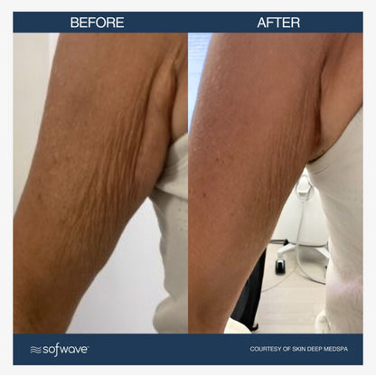 Sofwave (Ultrasound-based Skin Tightening)