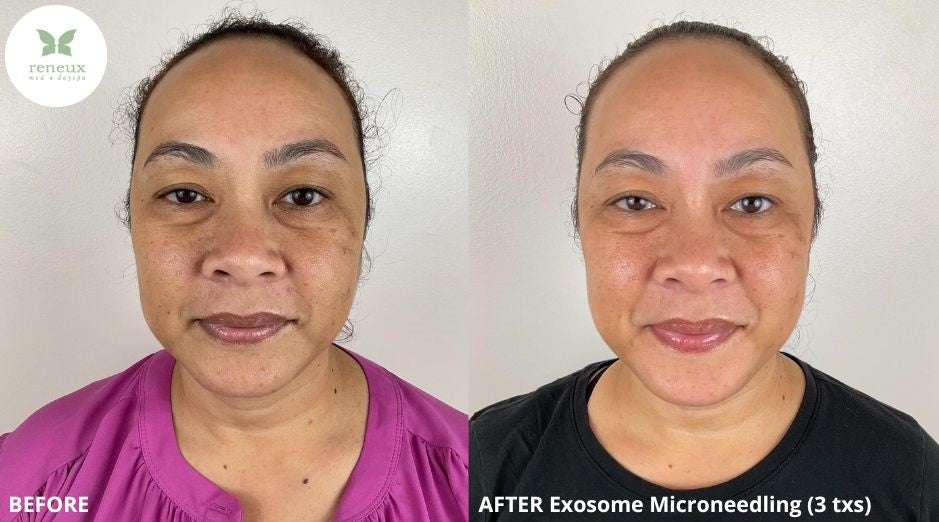 Microneedling