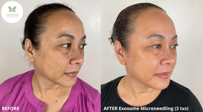 Microneedling
