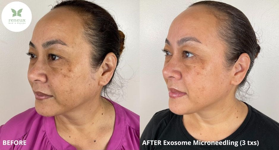 Microneedling – Reneux Med & Day Spa