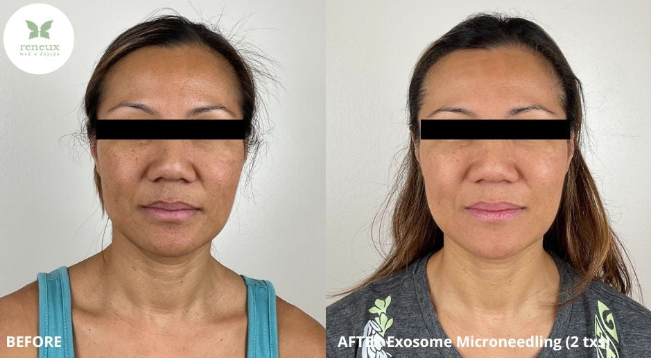 Microneedling – Reneux Med & Day Spa