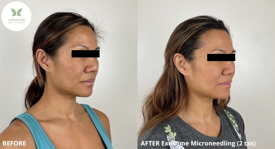 Microneedling