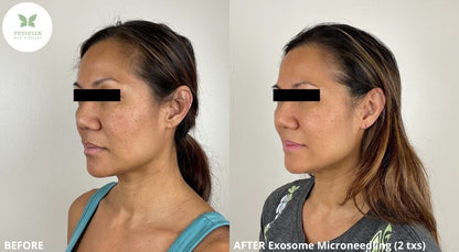 Microneedling