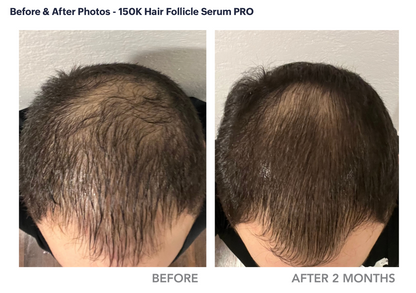 DefenAge 150K Hair Follicle Serum (3-month supply)