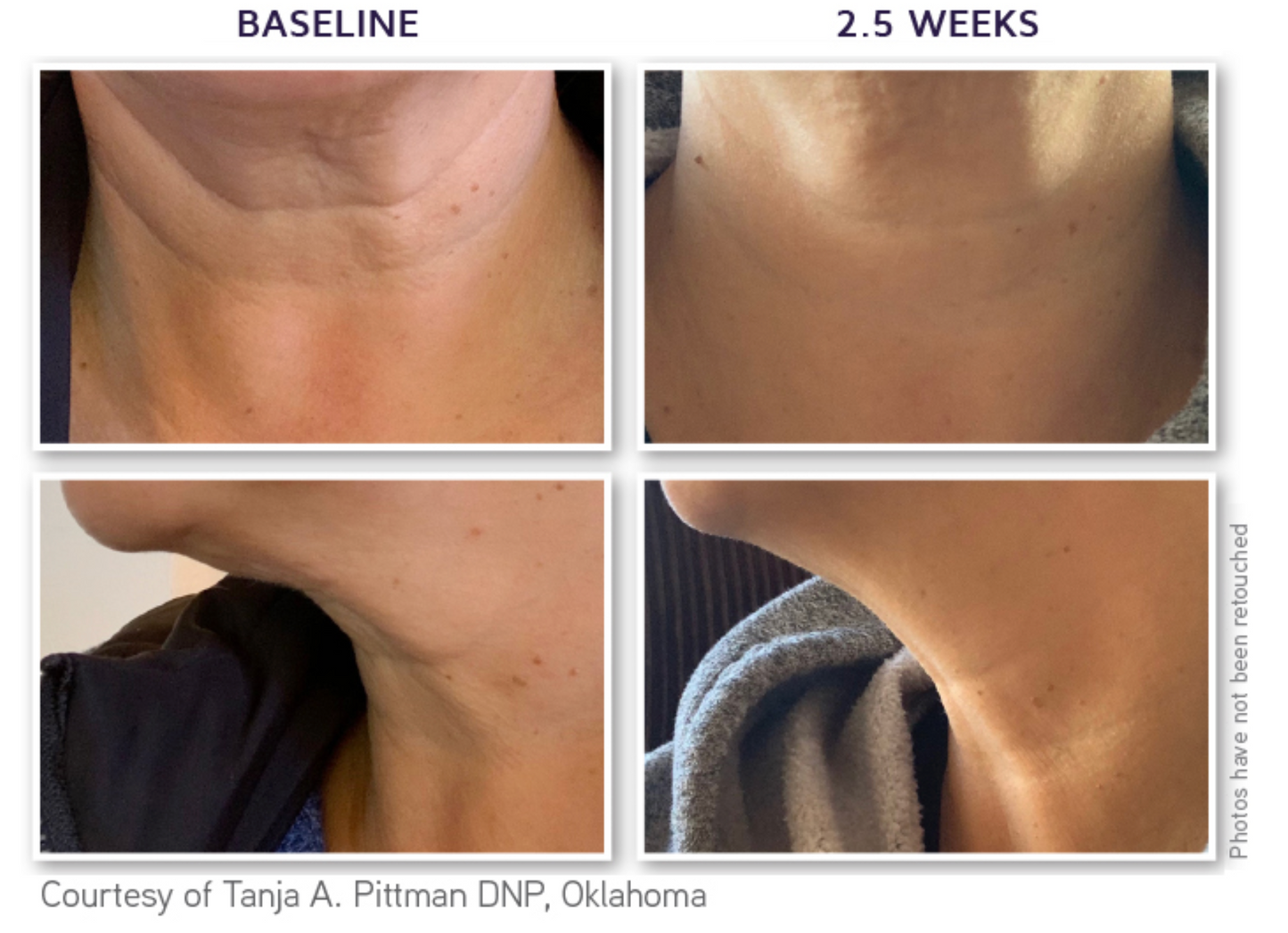 DefenAge 6 Week Neck Perfection Cream