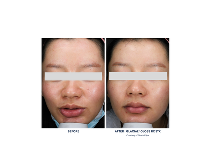GlacialRx Facial