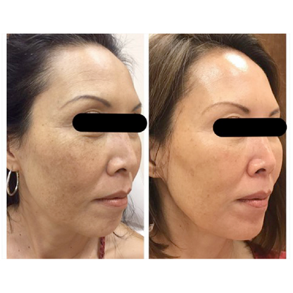 Chemical Peel