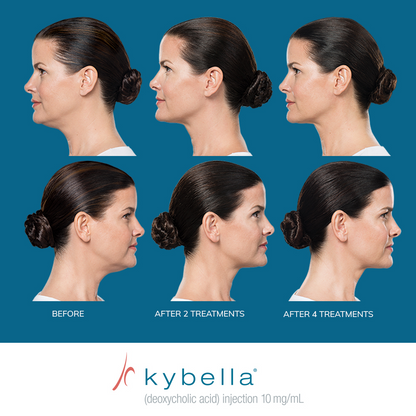 Kybella®
