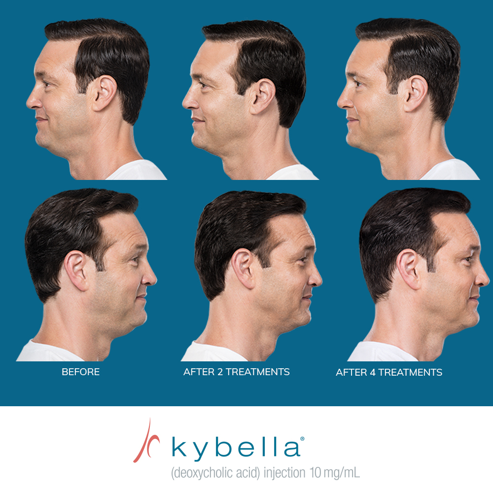 Kybella®