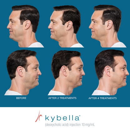 Kybella®