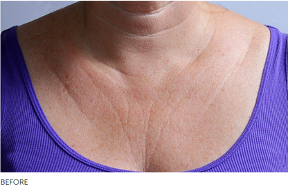 SilcSkin Decollette Pads