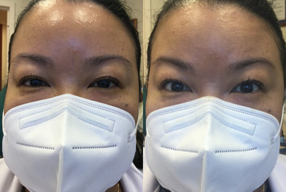 UPNEEQ® (30 single-use containers)