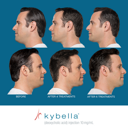 Kybella®