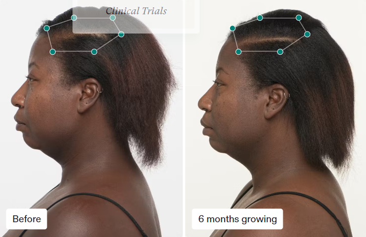 Nutrafol Women's (3-Month Supply)