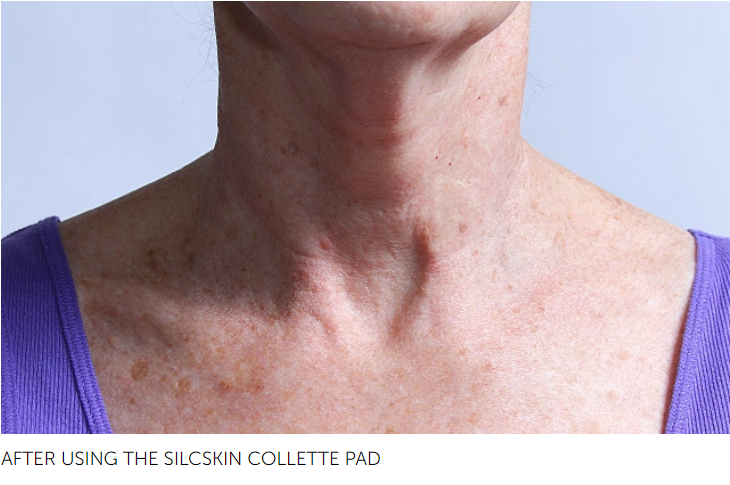 SilcSkin Collette Pads