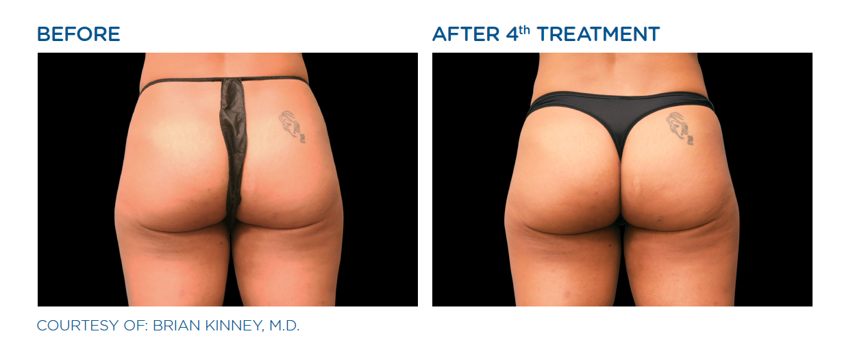 EMSCULPT®