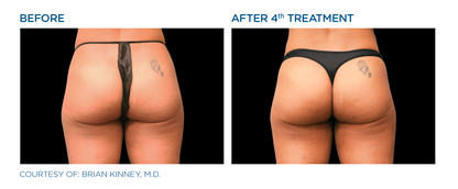 EMSCULPT®