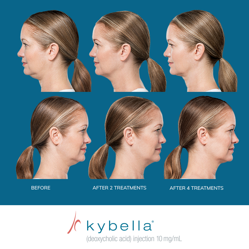 Kybella®