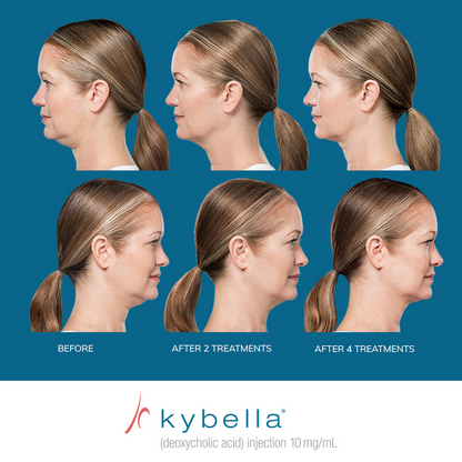 Kybella®