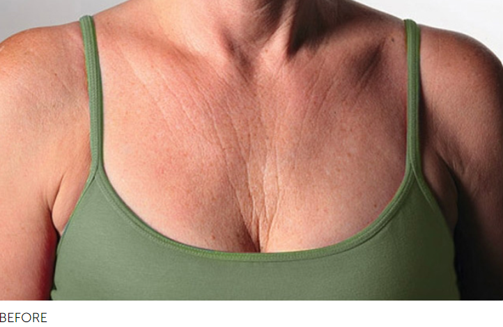 SilcSkin Decollette Pads