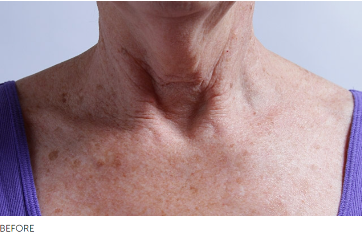 SilcSkin Collette Pads