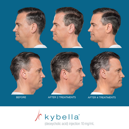 Kybella®