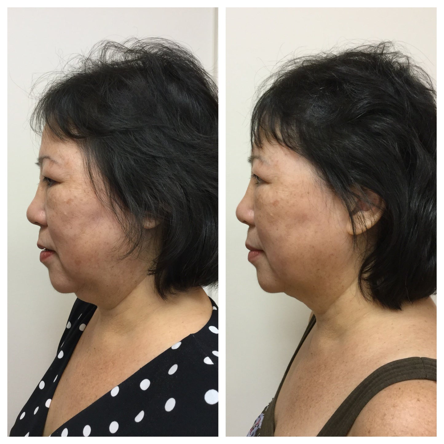 Kybella®