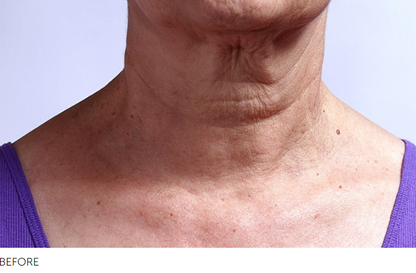 SilcSkin Collette Pads