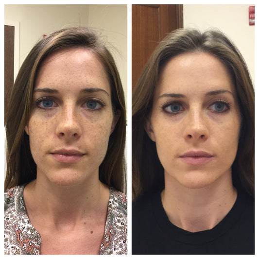 IPL (Intense Pulsed Light)