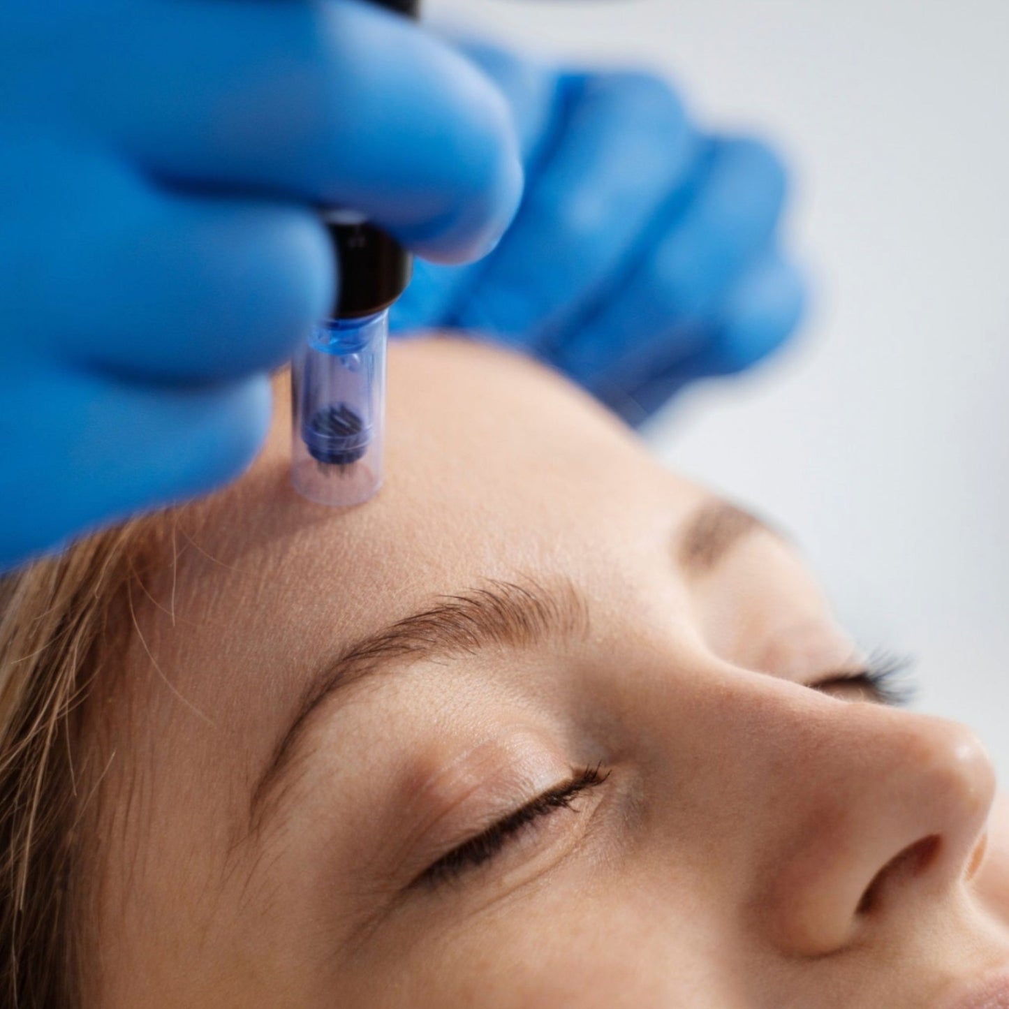 Microneedling