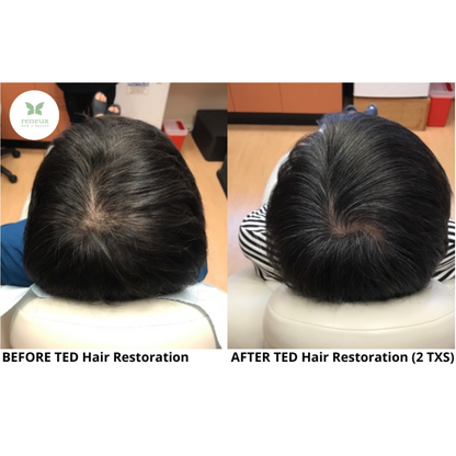 Alma TED Hair Restoration